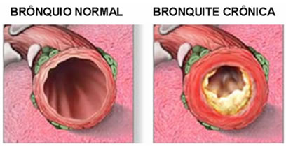 Bronquite