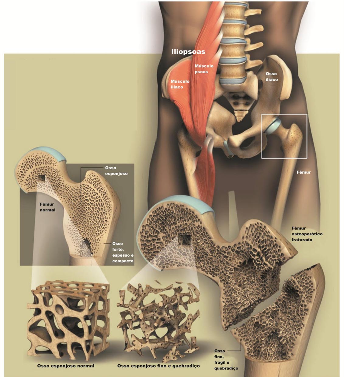 Osteopenia